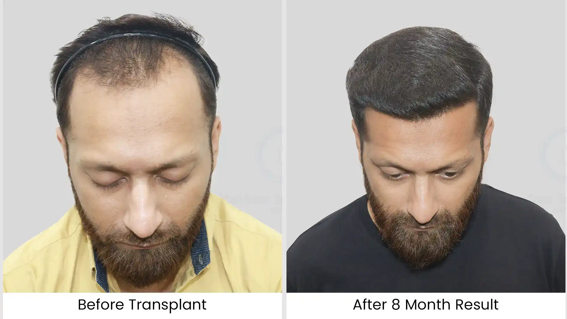 Latest Hair Transplant Technology in 2025: Advanced Techniques for Natural, Lasting Results 5 before after hair transplant - 1