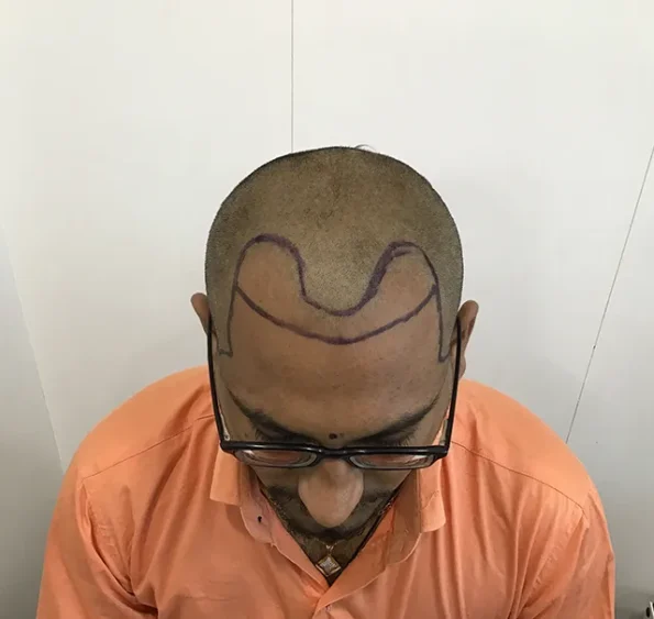Person with drawn design on scalp