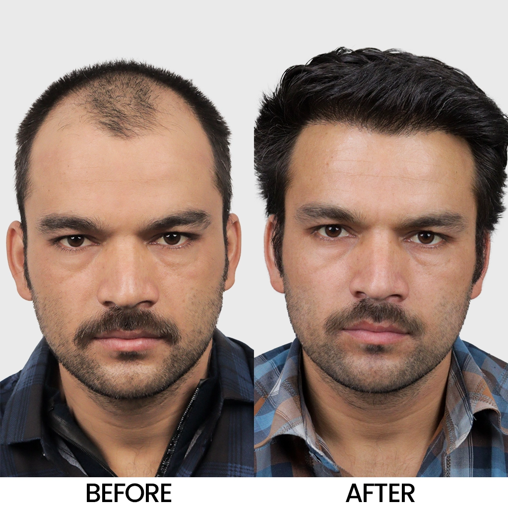 Big FUE hair transplant before and after result showing improved hair density