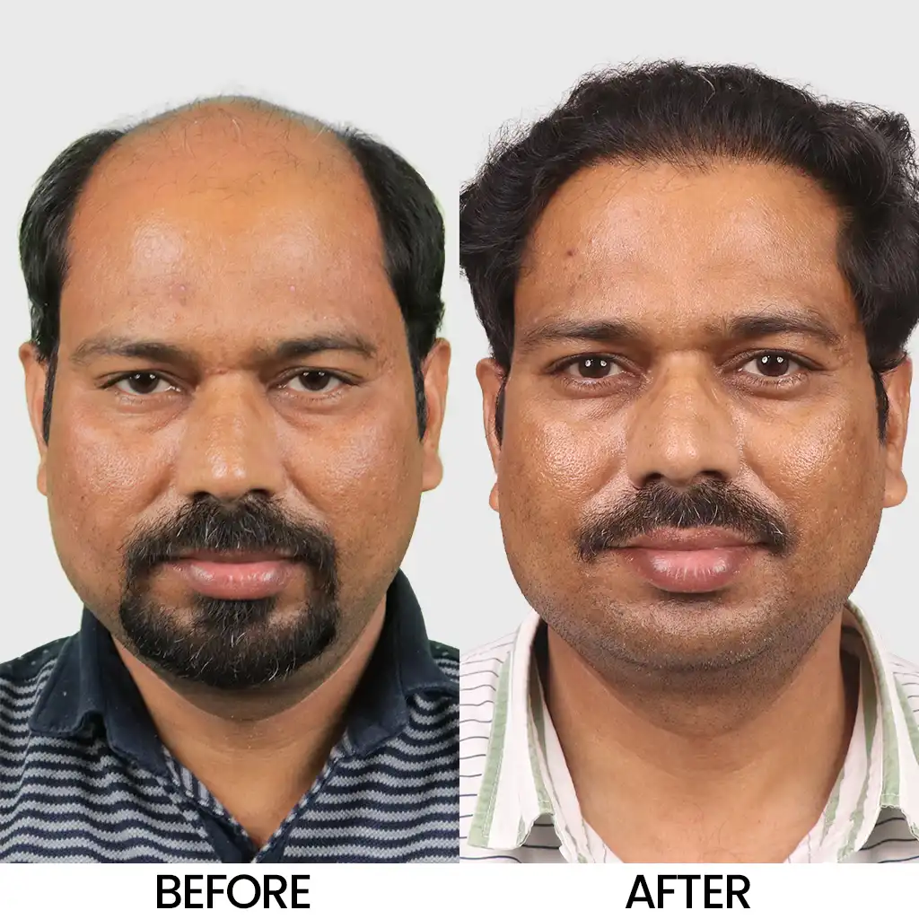 Big FUE hair transplant before and after result showing improved hair density
