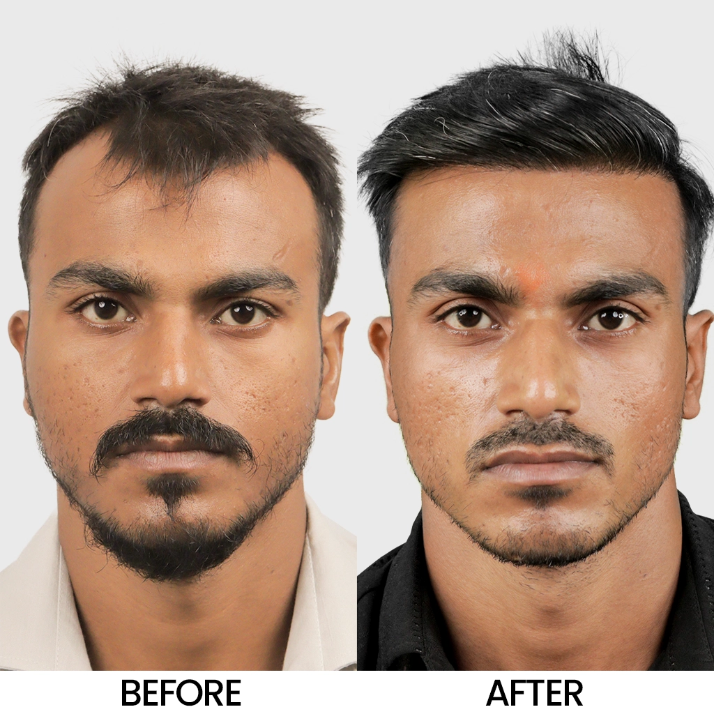 Bio FUE before and after result showing improved hair density