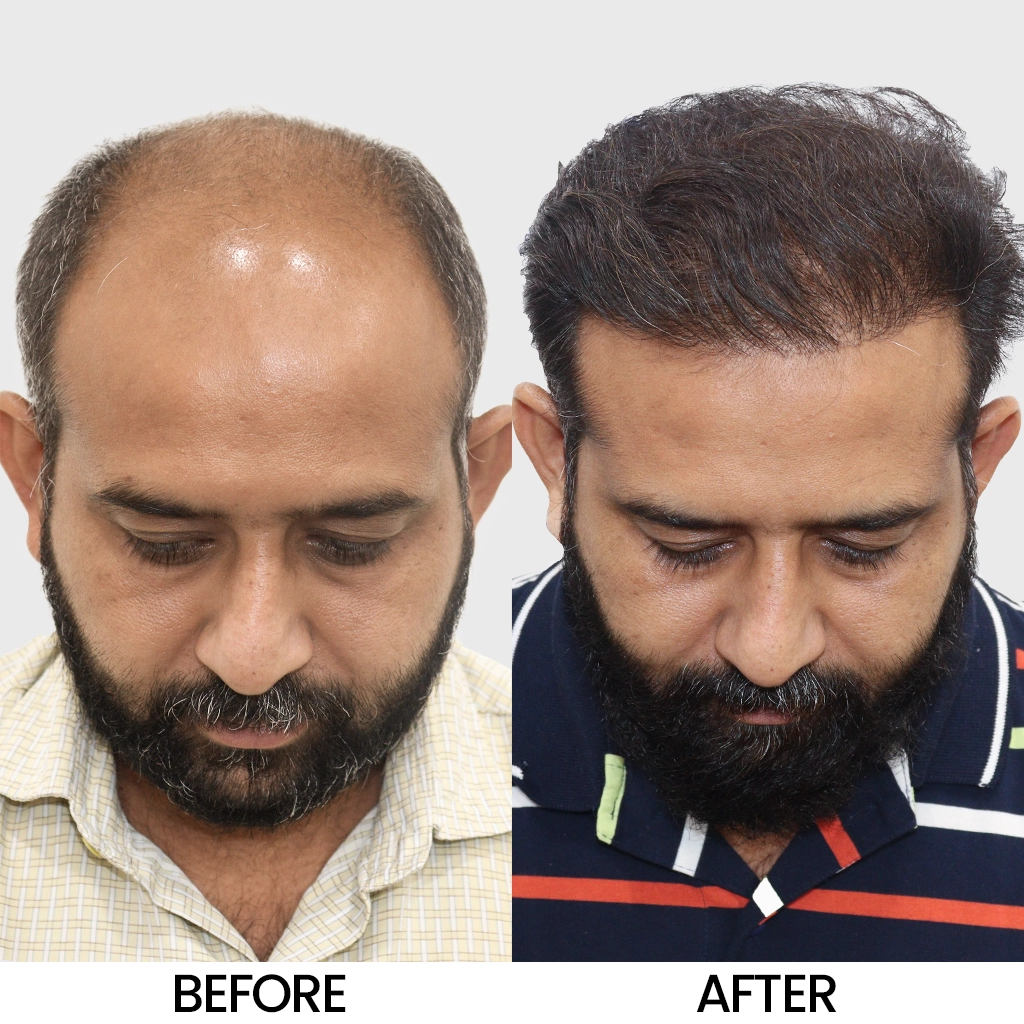 Bio FUE before and after result showing improved hair density – Hair Transplant Cost in Jodhpur.