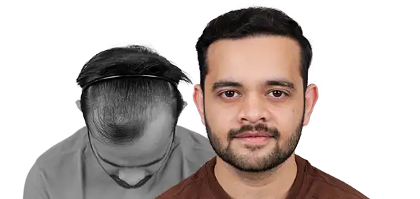 Hair Transplant Cost in varanasi patient review with before and after results