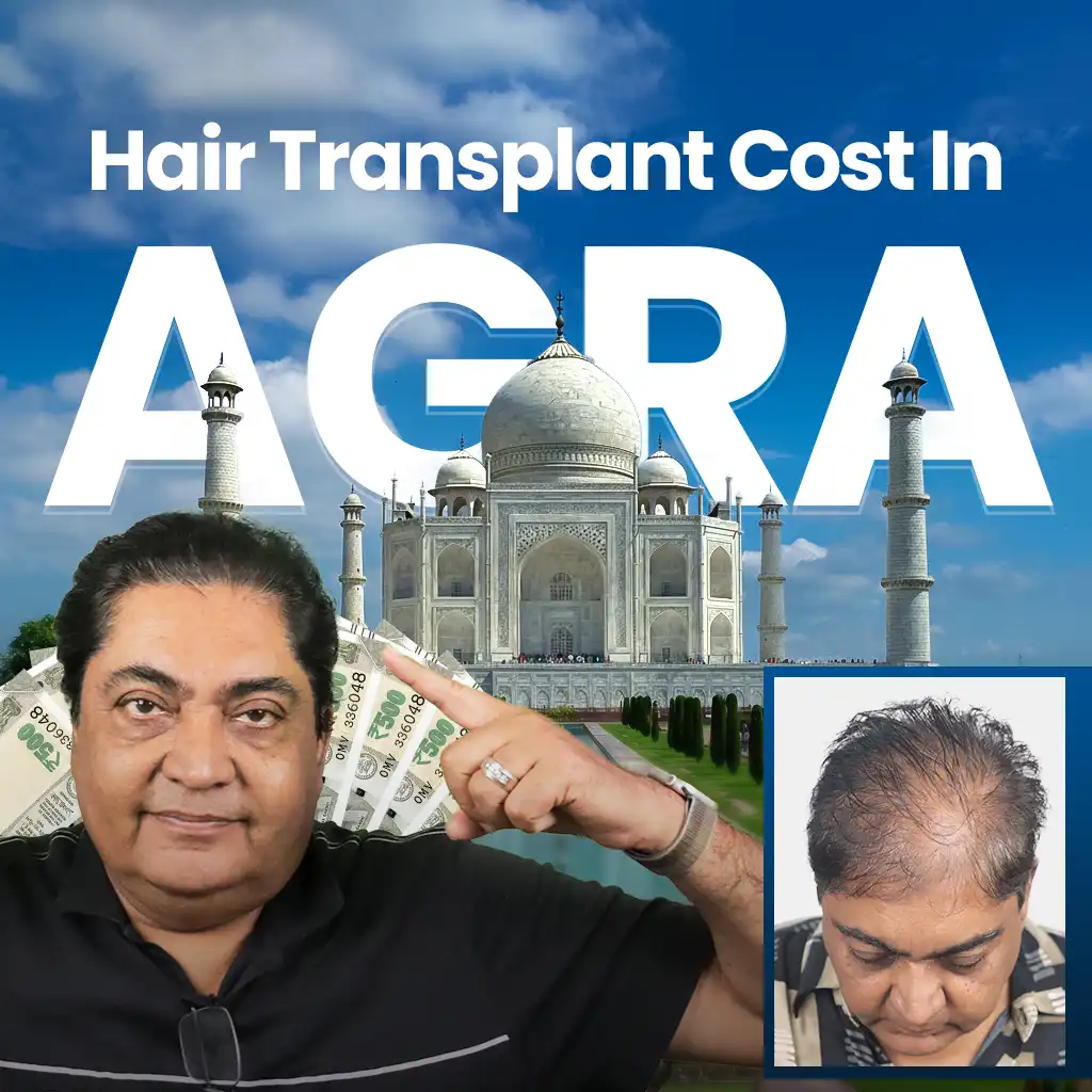 Promoting hair transplant services cost in Agra