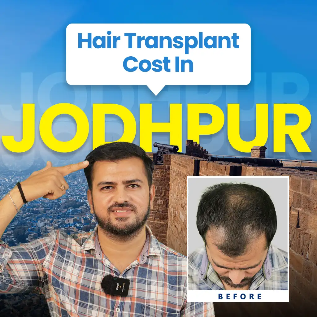 Promoting hair transplant services in Jodhpur