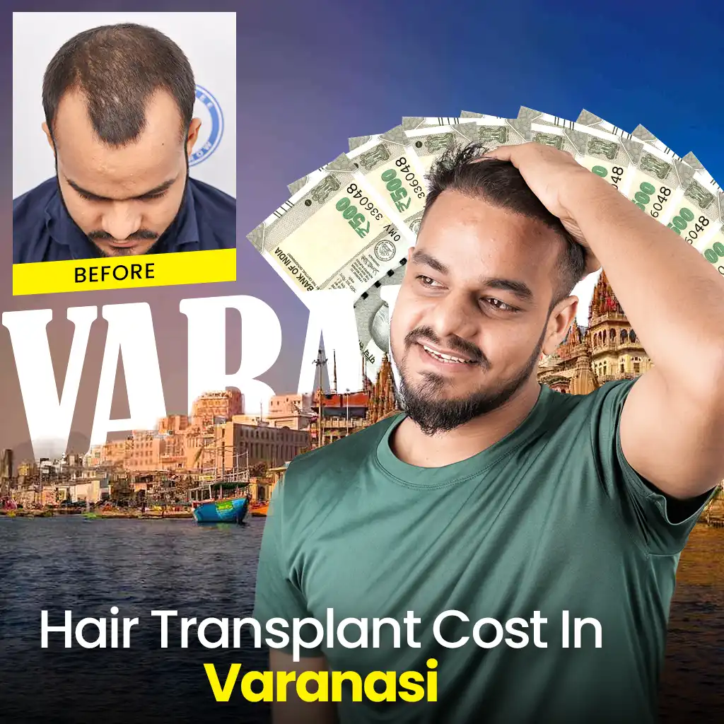 Promoting hair transplant services cost in Varanasi