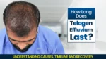 Man showing hair thinning explaining how long does telogen effluvium last