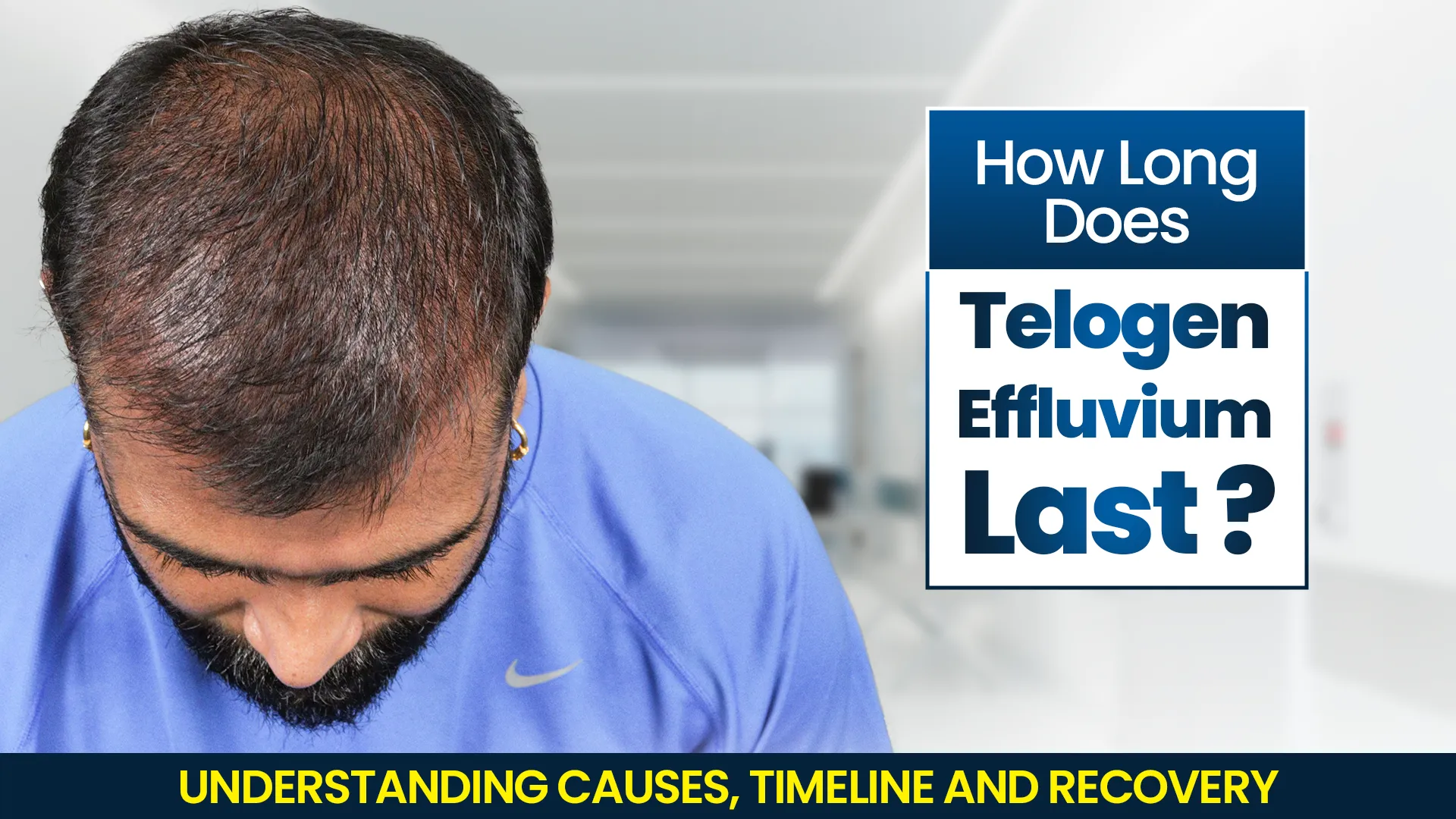 Man showing hair thinning explaining how long does telogen effluvium last