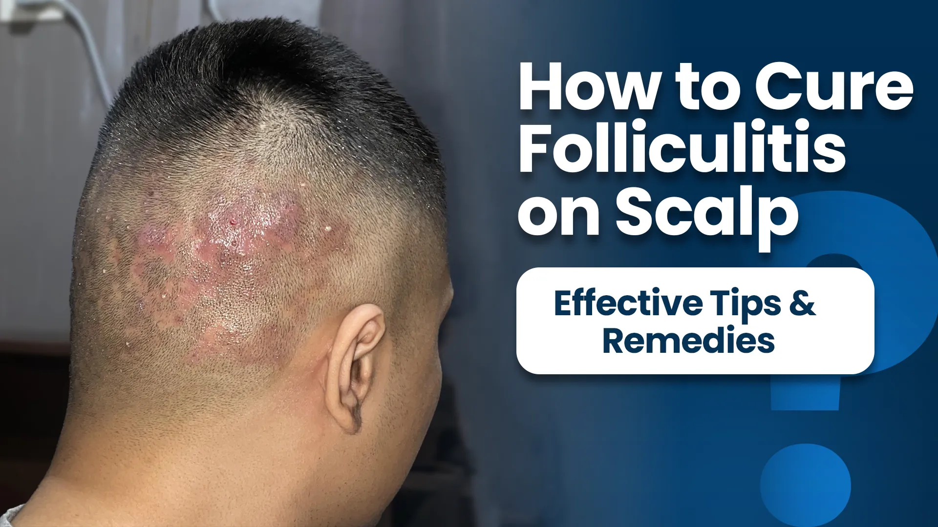 How to cure folliculitis on scalp with visible scalp infection