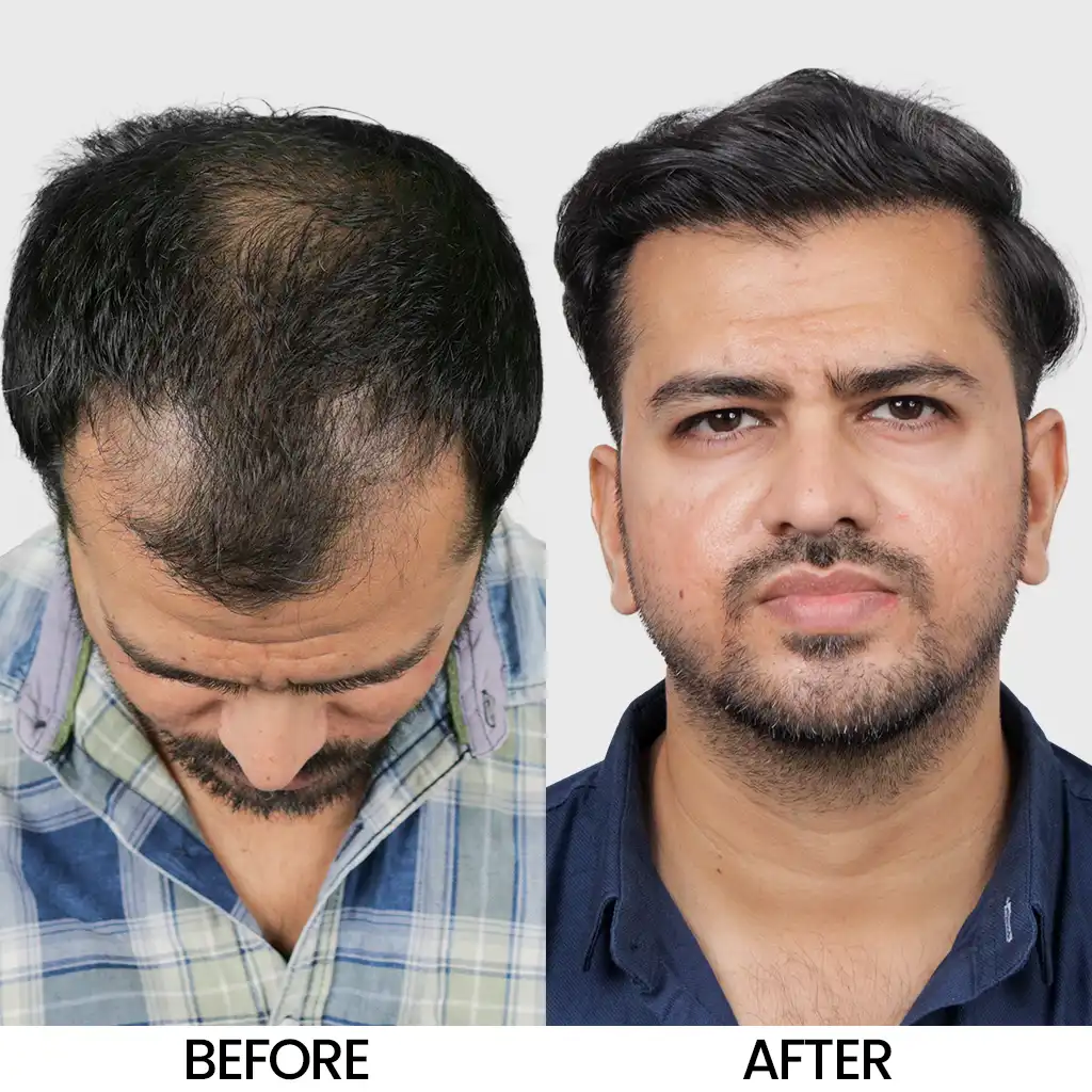 I FUE hair transplant before after result showing improved density – Hair Transplant Cost in Jodhpur