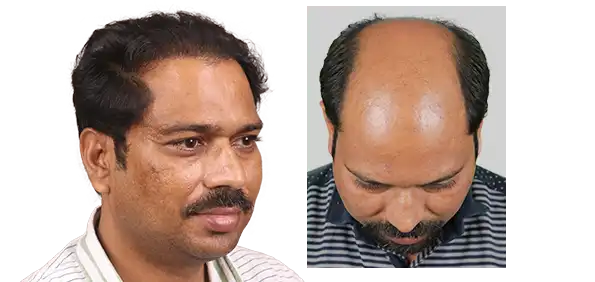 Hair Transplant Cost in Jodhpur patient review with before and after results