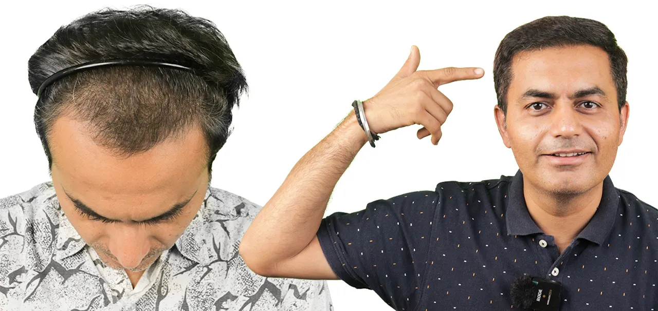 Medical Tourism for Hair Transplant in India 5 KASHYAP JARIWALA