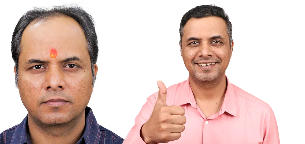 Medical Tourism for Hair Transplant in India 6 MANISH RAVAL