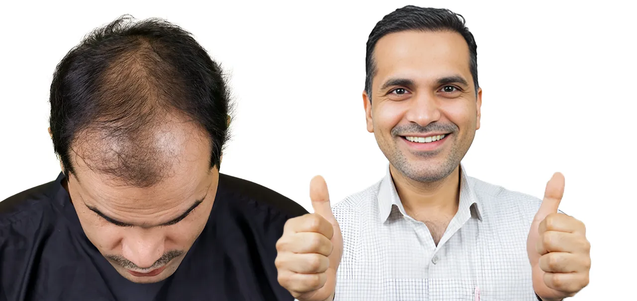 Medical Tourism for Hair Transplant in India 7 Before and after hair restoration