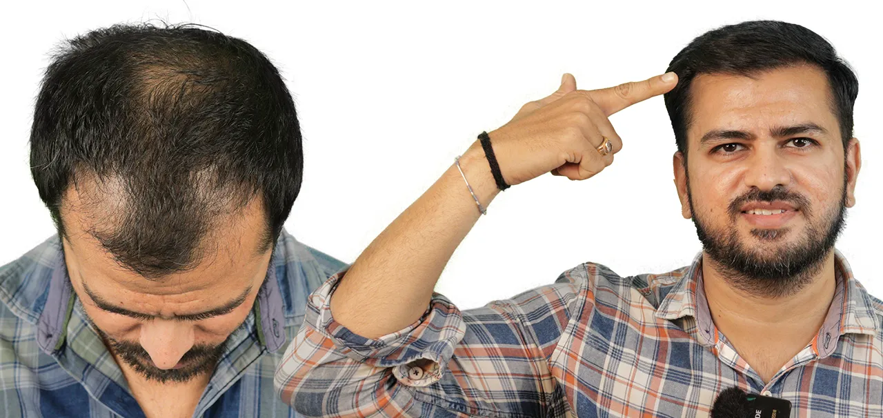 Medical Tourism for Hair Transplant in India 8 RAHUL G BARIA