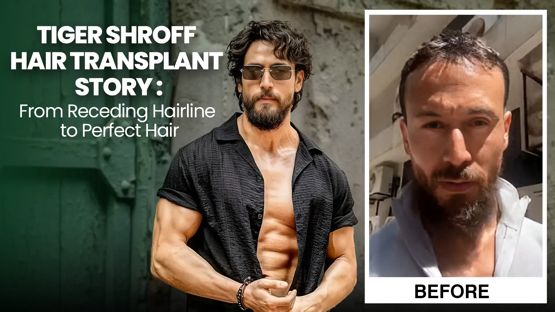 Tiger Shroff's Transformation from receding to perfect hair.