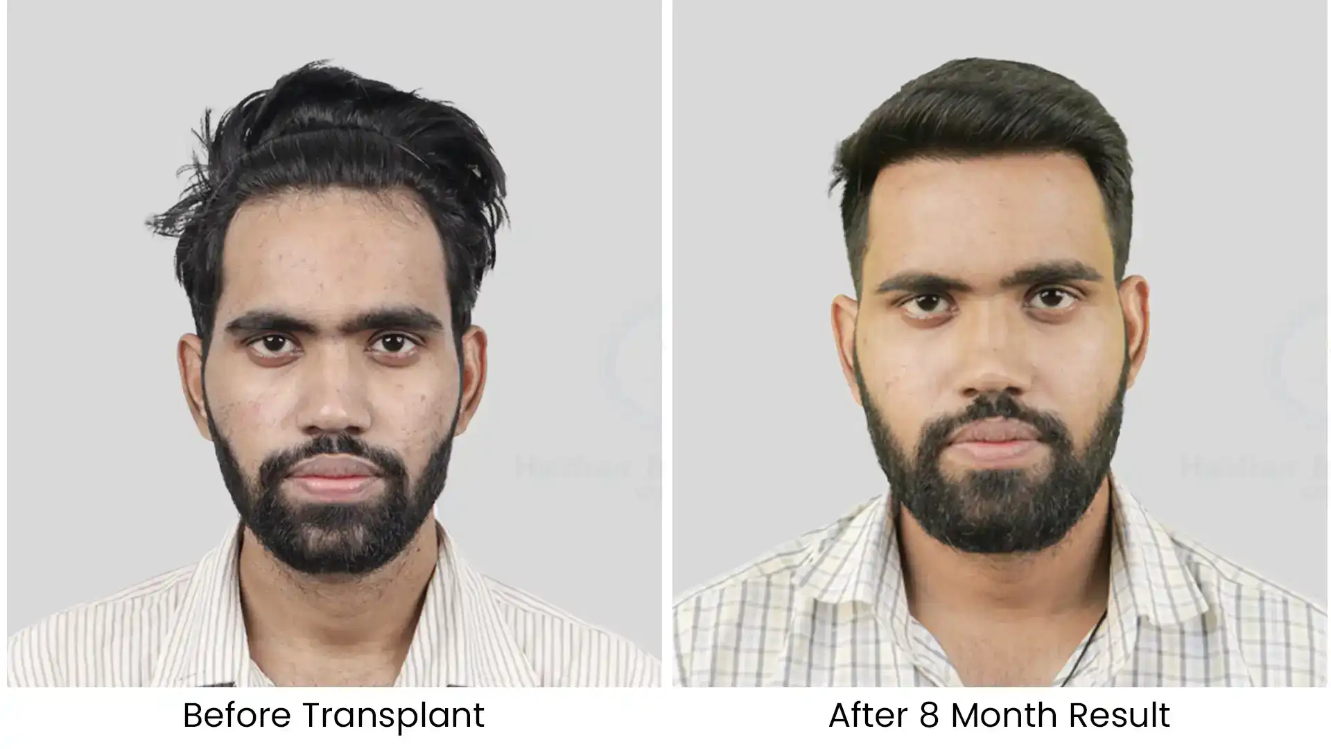 before after hair transplant - 2