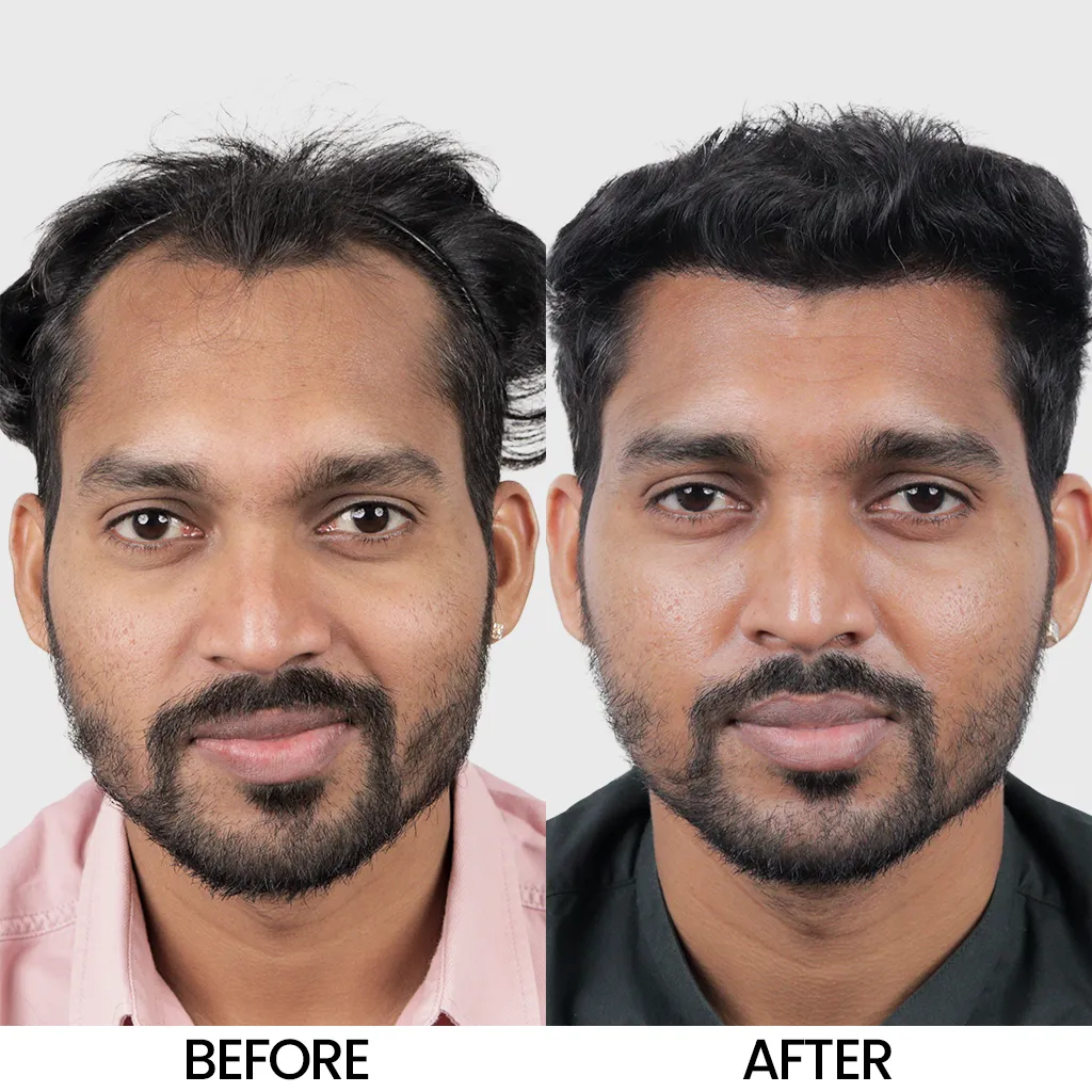 Big FUE hair transplant before and after result showing improved hair density