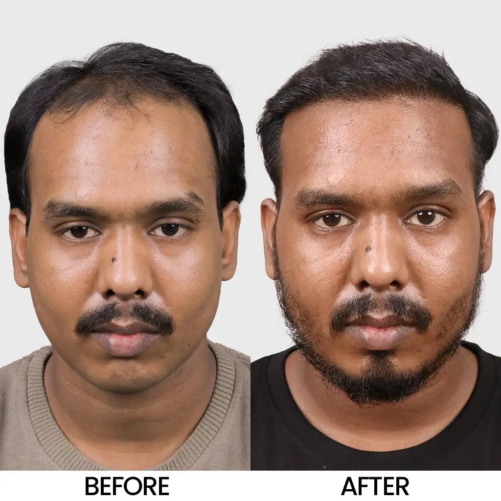 Bio FUE before and after result showing improved hair density – Hair Transplant Cost in Baroda.