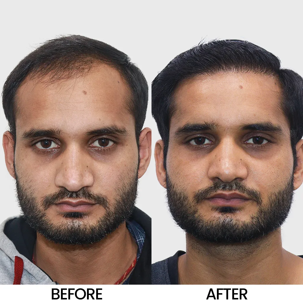 Bio FUE before and after result showing improved hair density – Hair Transplant Cost in Bhubaneswar