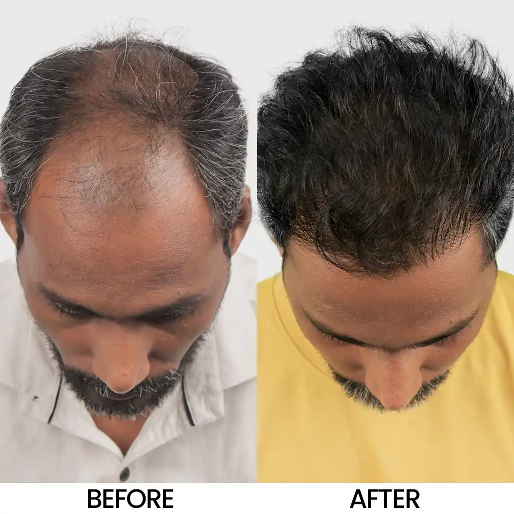 Hair Transplant Cost in Ranchi BIO FUE before and after results showing fuller hair growth