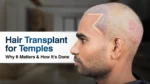 Hair Transplant for Temples procedure showing temple area graft placement