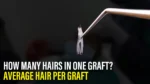 Hair graft held with forceps showing follicles, how many grafts do I need for hair transplant