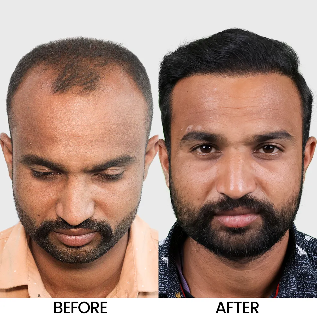 I FUE hair transplant before after result showing improved density – Hair Transplant Cost in Bhubaneswar