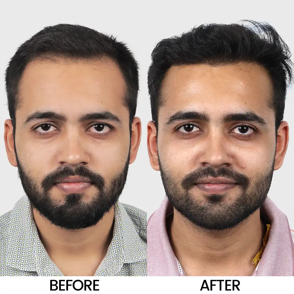 I FUE hair transplant before after result showing improved density – Hair Transplant Cost in Baroda