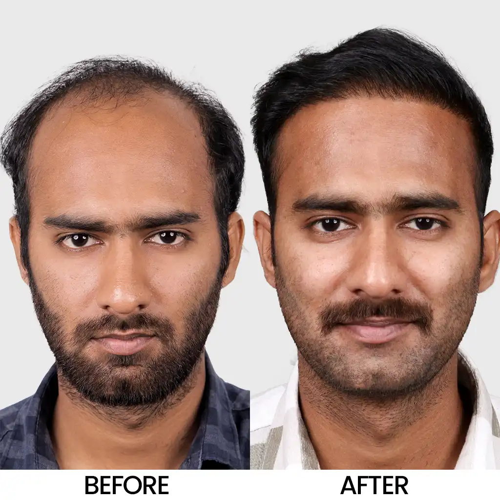 Hair restoration before and after