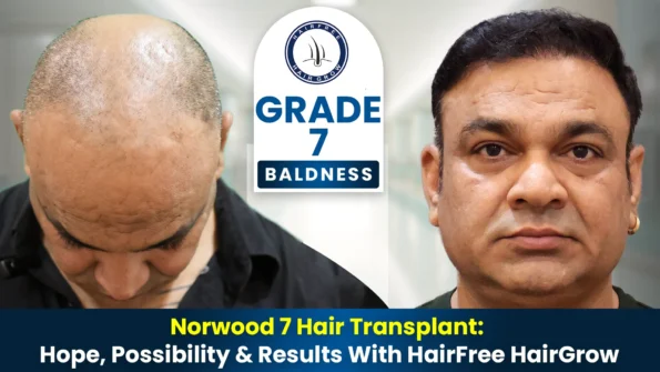 Norwood 7 Hair Transplant before and after results showing advanced baldness improvement