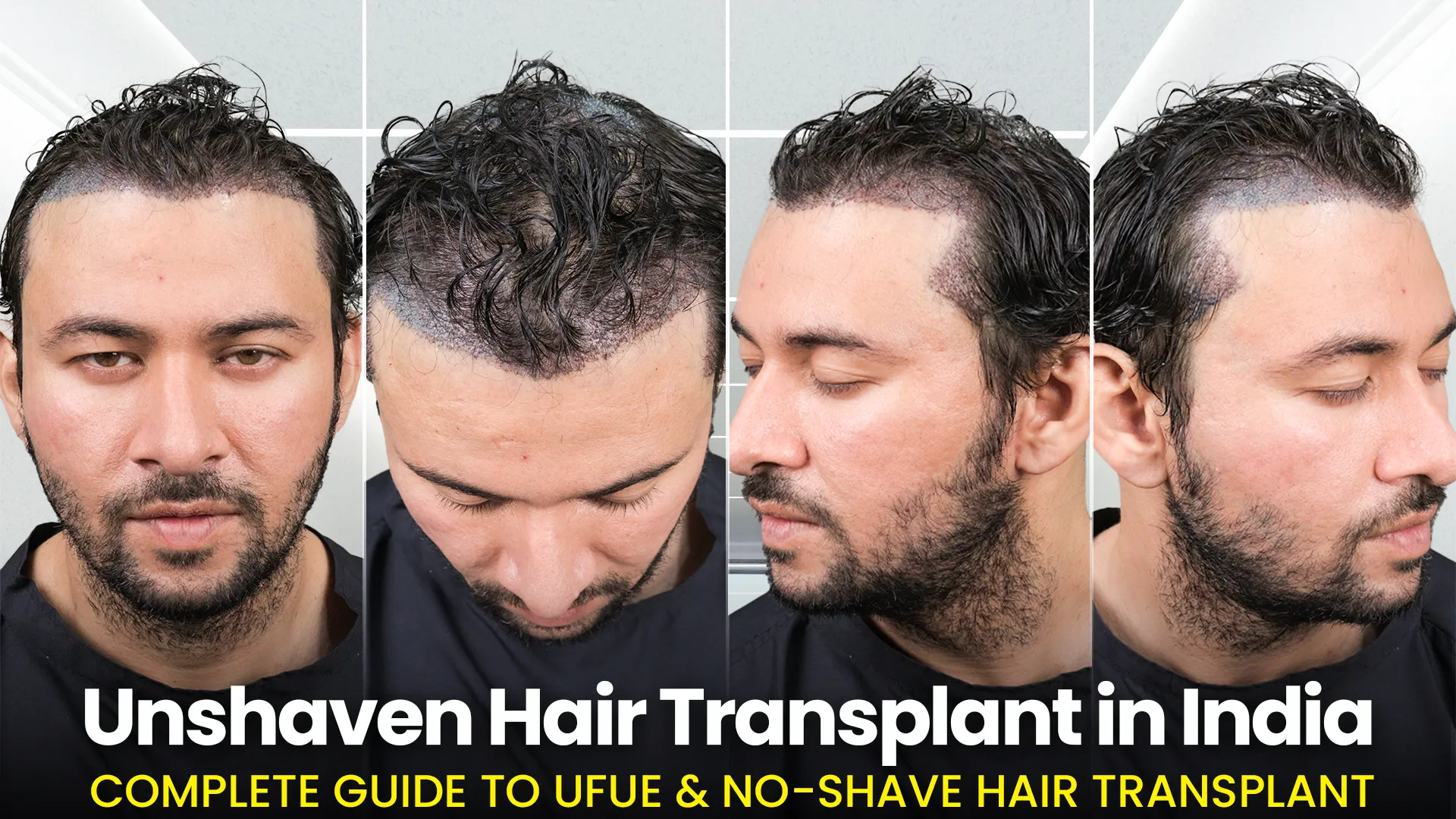 Unshaven Hair Transplant results showing hairline and scalp views in India