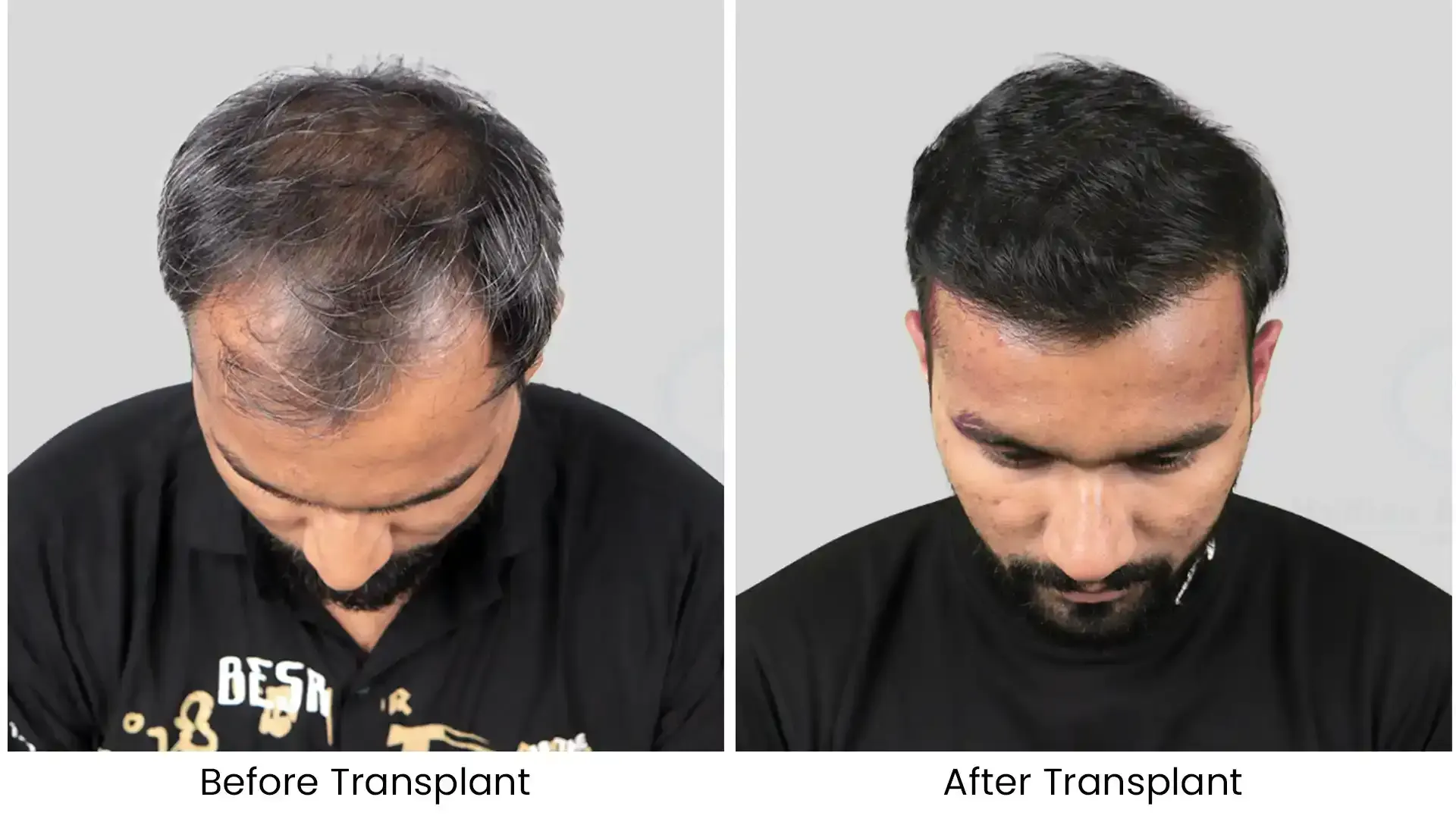 Unshaven Hair Transplant in India: Complete Guide to UFUE & No-Shave Hair Transplant 1 hair transplant before after - 4