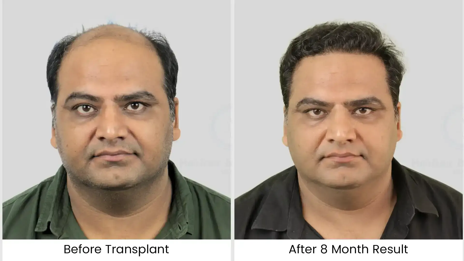 hair transplant before-after image - 3