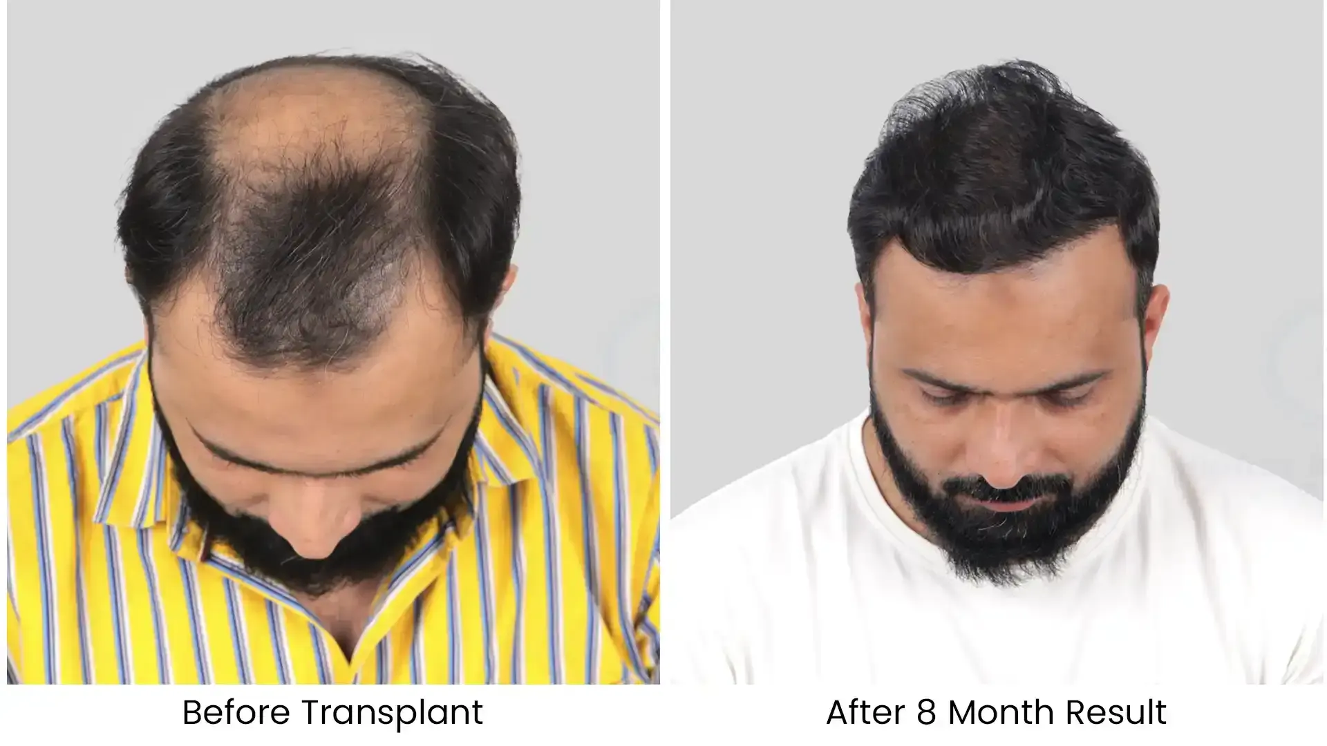 hair transplant before after photo - 1