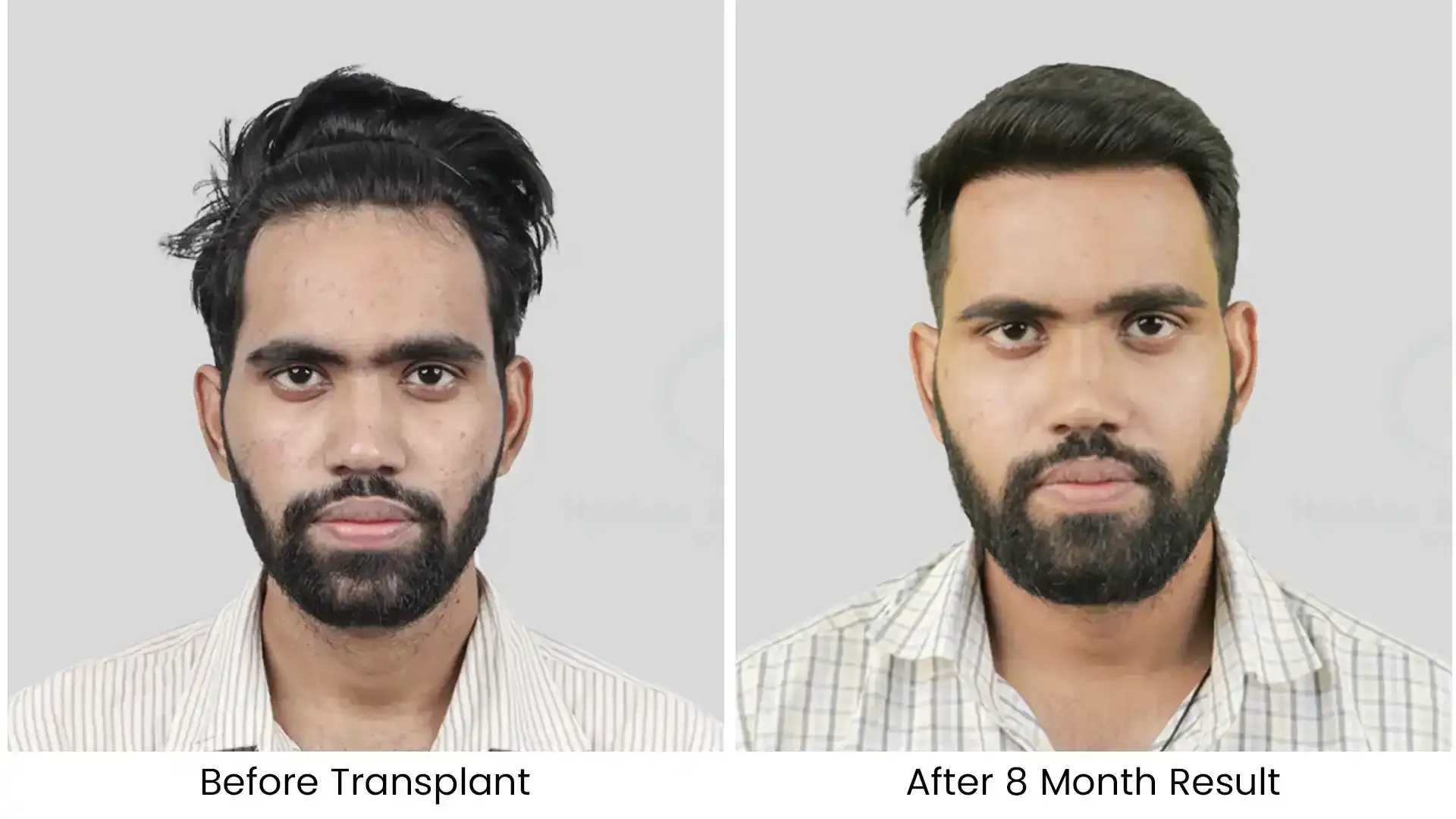 hair transplant before after photo - 1