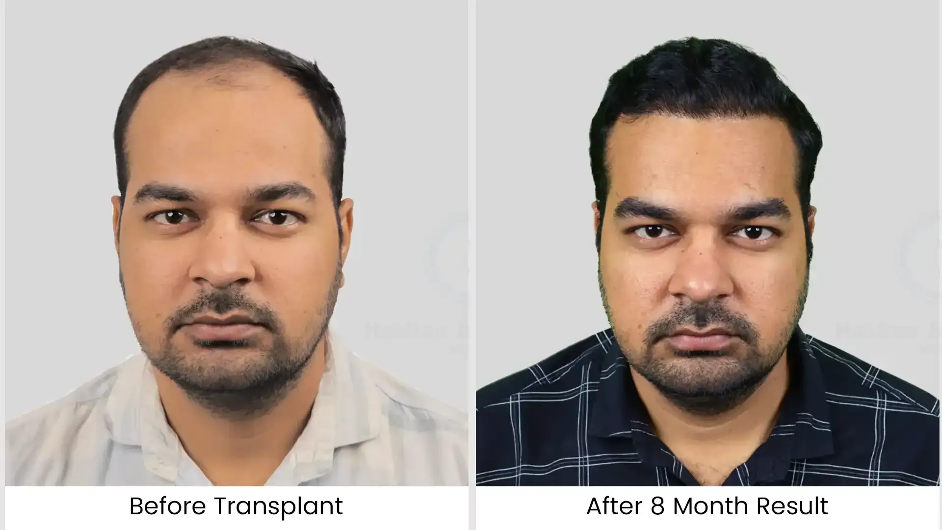 hair transplant before after photo 1
