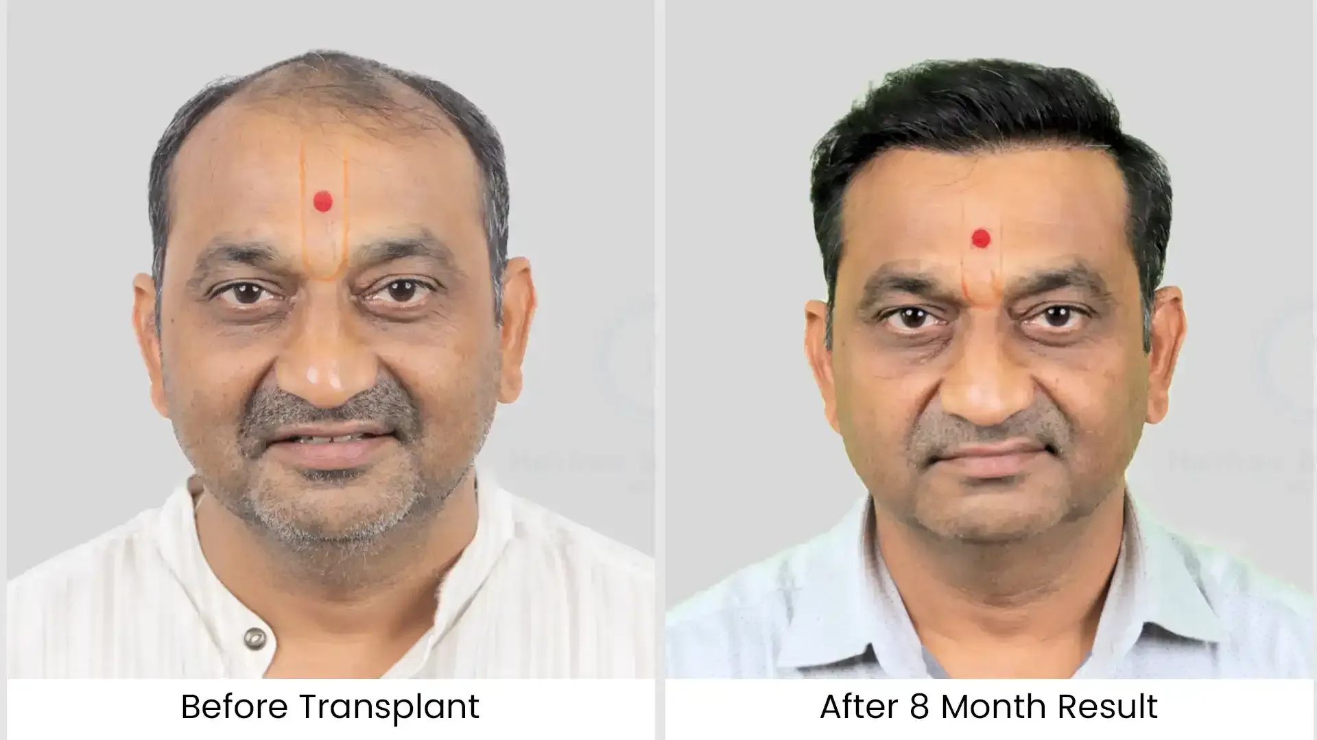 hair transplant before after photo - 2