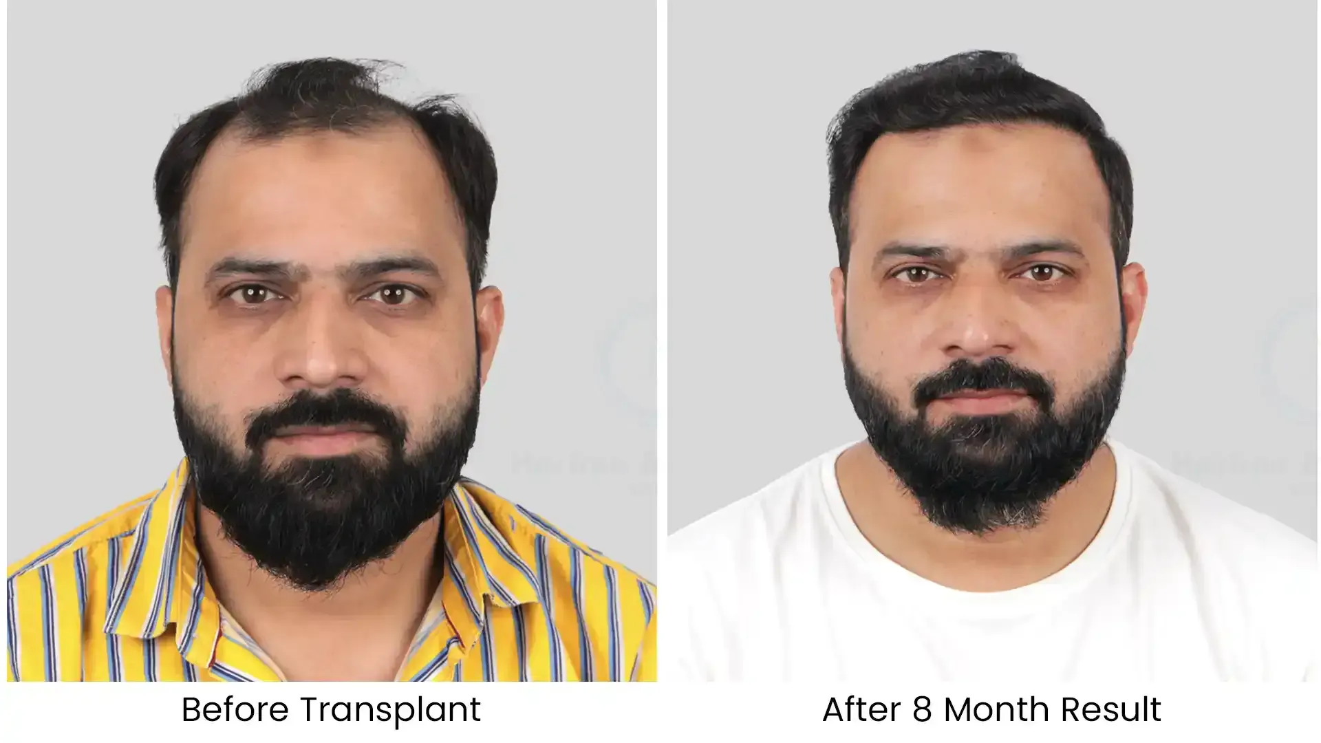 hair transplant before after photo - 3