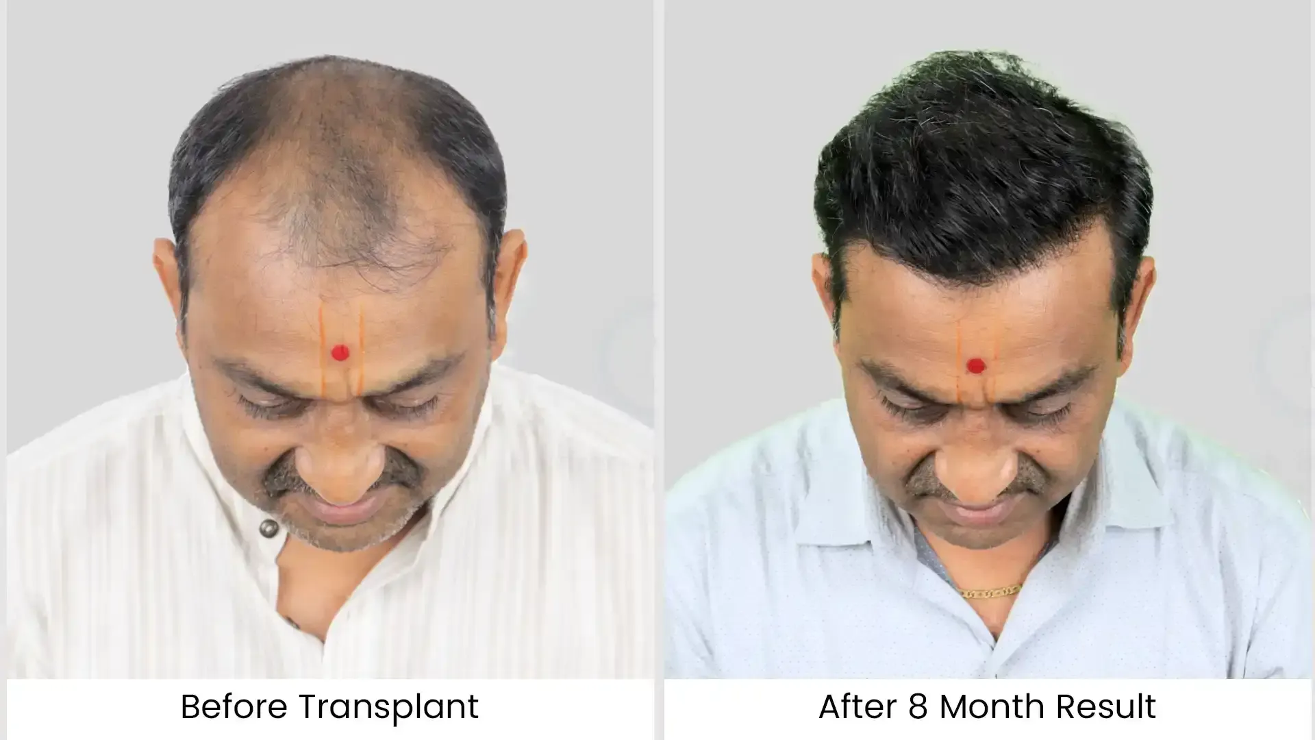 hair transplant before after photo - 4