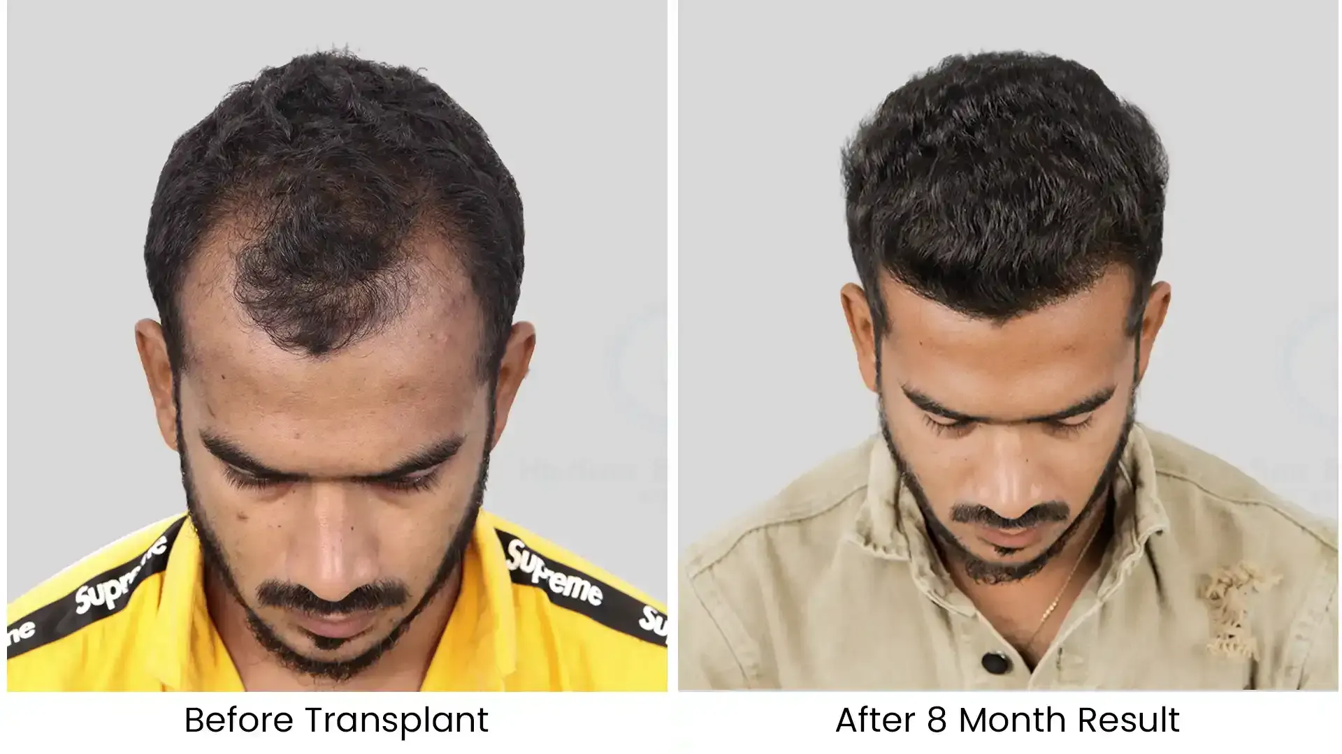 hair transplant before after photo - 4