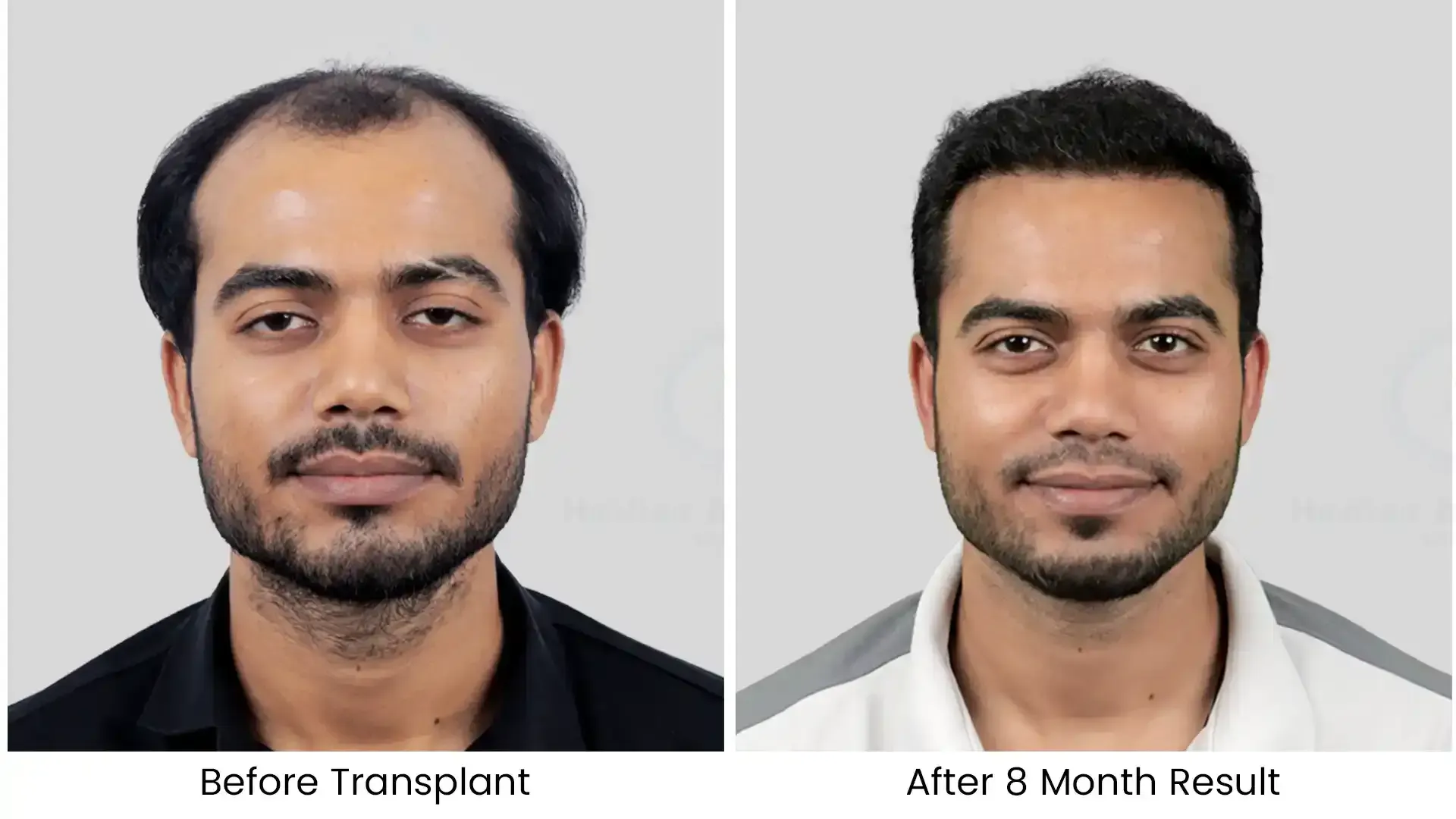 Hair Transplant Cost in Bhubaneswar 17 hair transplant before - after photos - 2