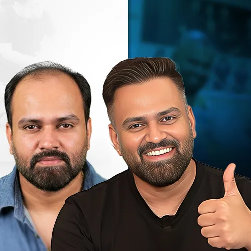 Get Fuller Hair This Holiday Season <br>Unbeatable offer running Now!! <br>Limited Time Only