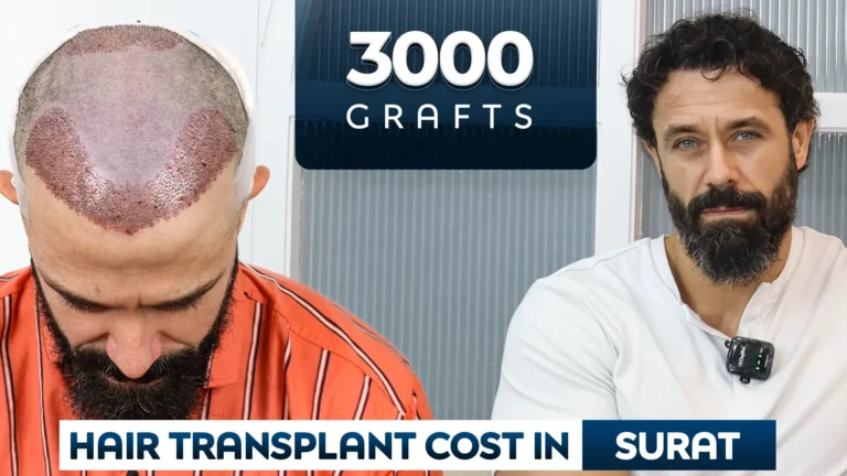 3000 Grafts hair transplant cost in surat cost