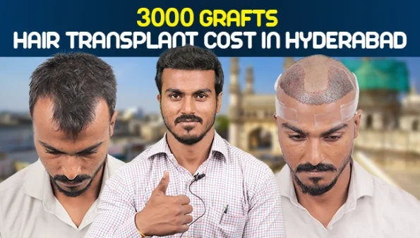 3000 grafts hair transplant cost in Hyderabad