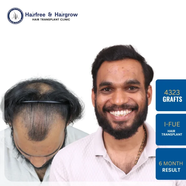4000 grafts hair transplant