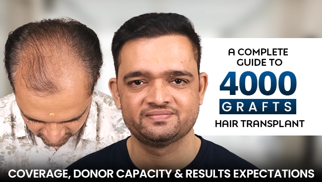 A-Complete-Guide-to-4000-Grafts-Hair-Transplant-Coverage-Donor-Capacity-Results-Expectations