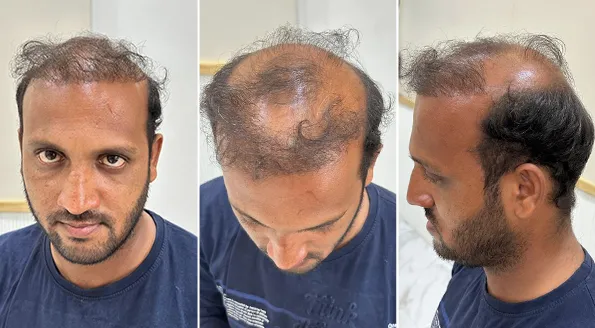 hair transplant repair