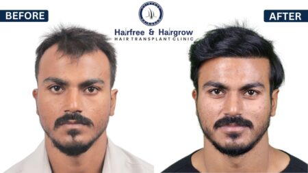 hair transplant result at Hairfree Hairgrow