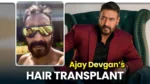 Ajay Devgan Hair Transplant